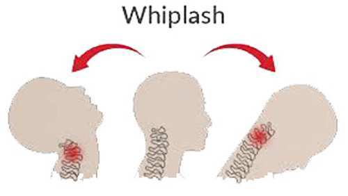 Some advice for patients with whiplash injury