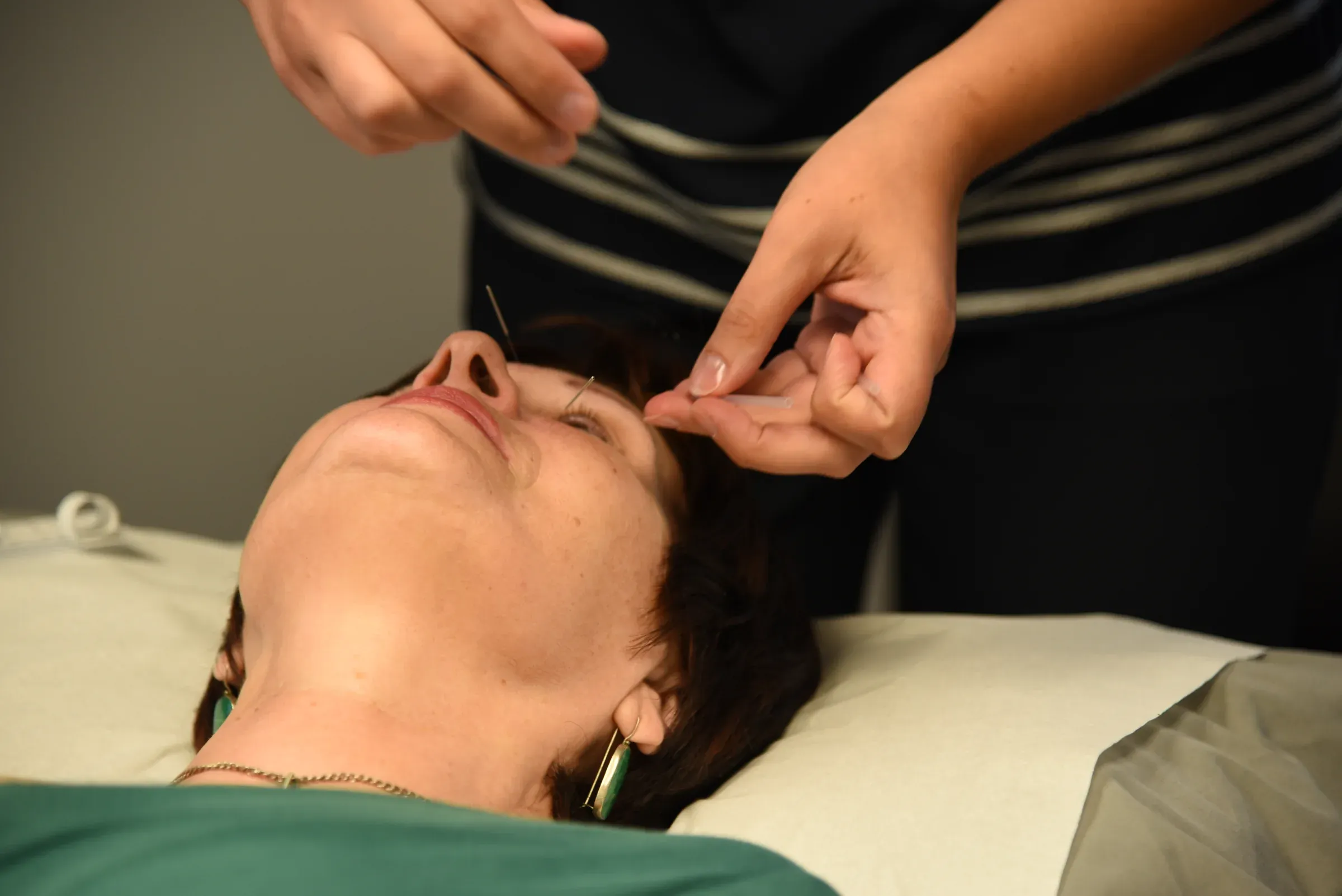 Acupuncture treatment at Physiotrust
