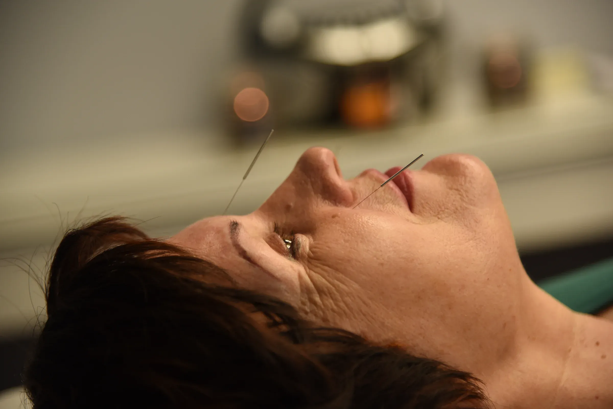 Acupuncture care at Physiotrust